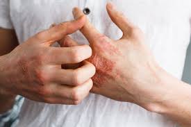 How to Distinguish a Rash to Find the Right Treatment 1